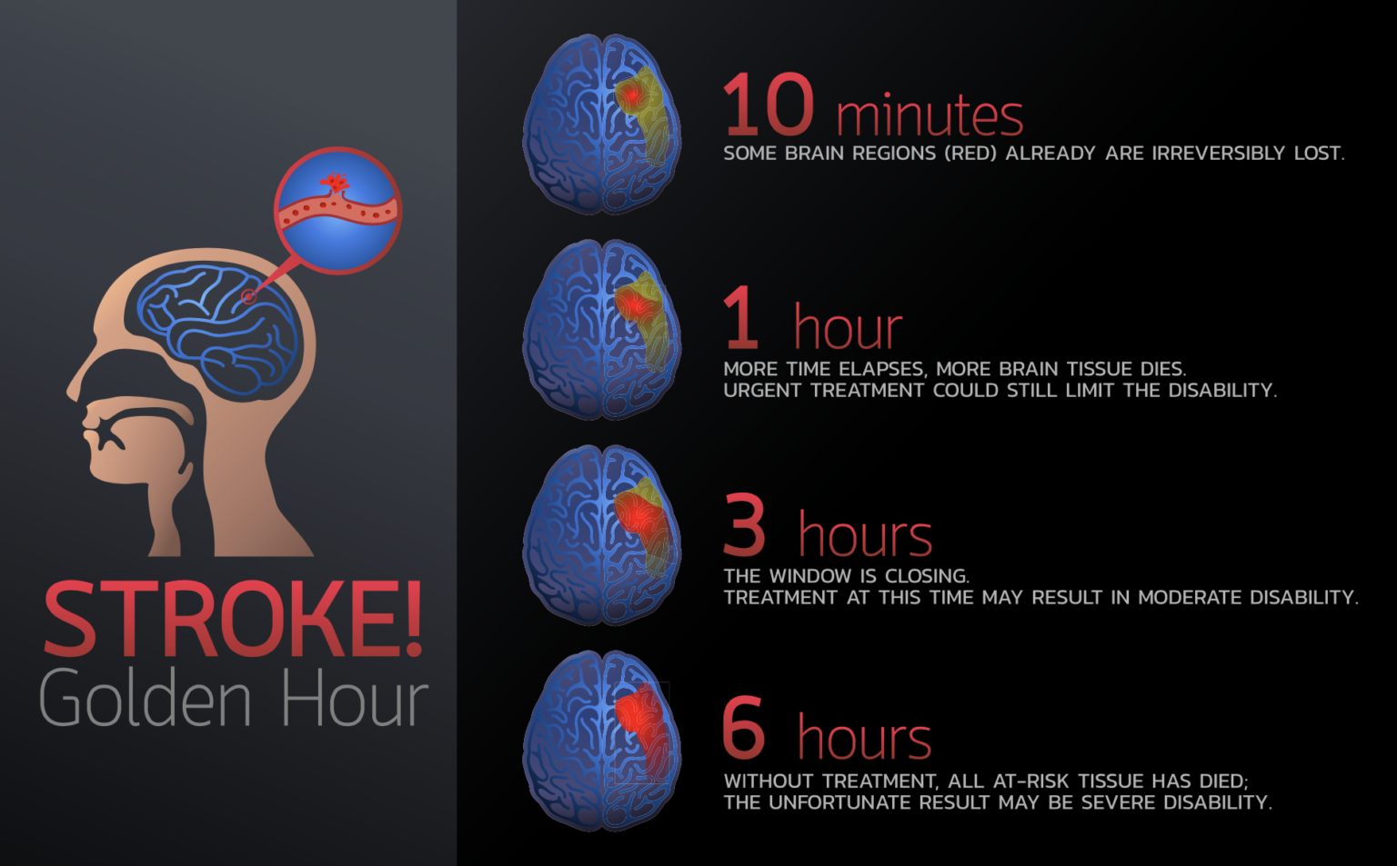  MRI はサイレント脳卒中を検出できますか?